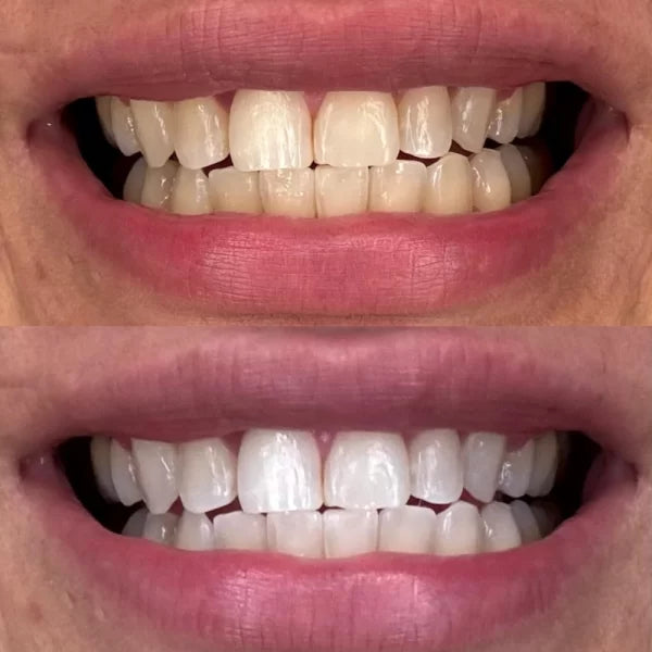 Traitement Crest 3D White – Luxe Professional Effects.